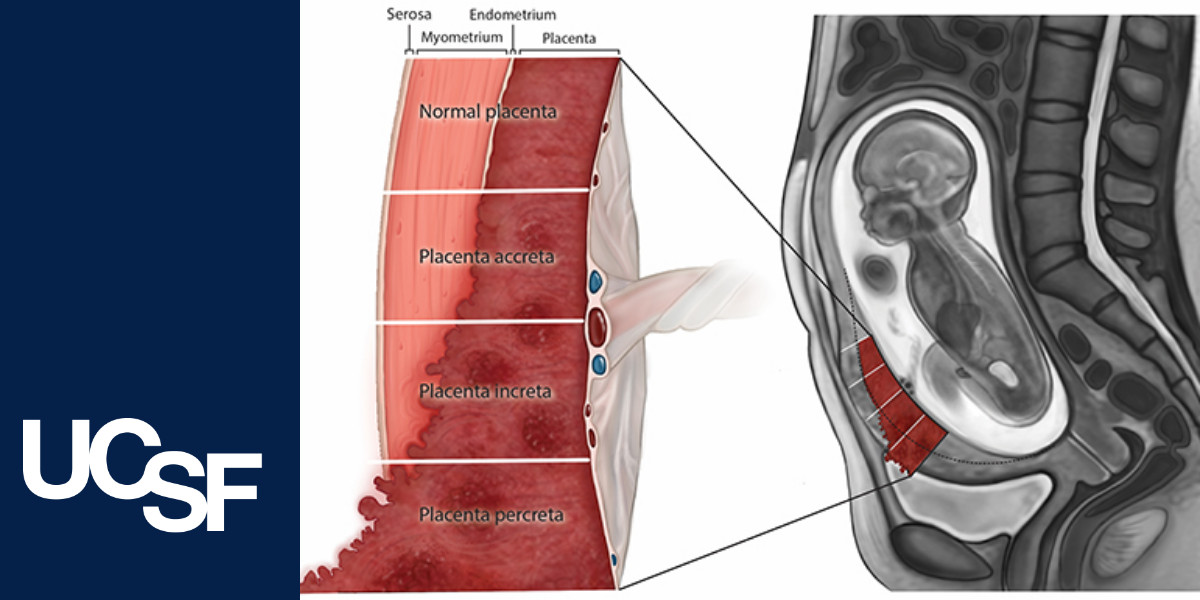 ucsf-radiology-s-role-in-the-multidisciplinary-approach-to-the-placenta